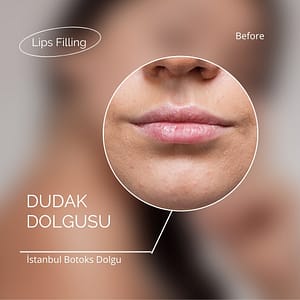 Dudak dolgusu fiyatları ne kadar?