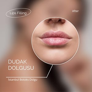 Dudak dolgusu fiyatları ne kadar?