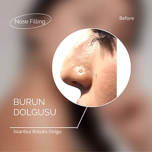 Burun Dolgusu Ataşehir 