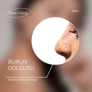 Burun Dolgusu Ataşehir 